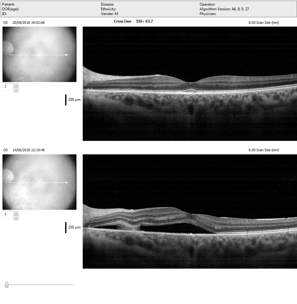 laser_giallo_iridex_oculista_torchia_4