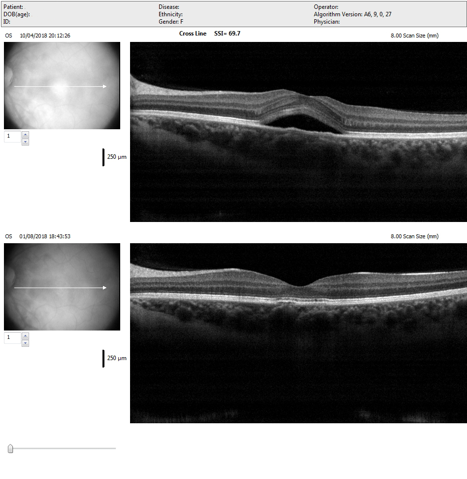laser_giallo_iridex_oculista_torchia_5