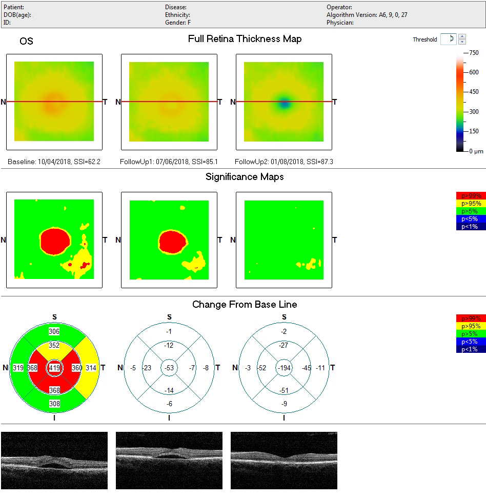 laser_giallo_iridex_oculista_torchia_6