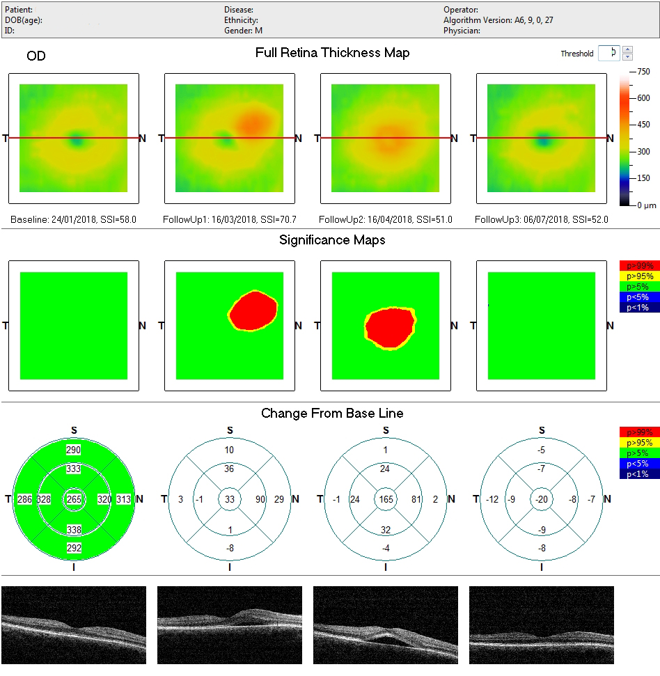 laser_giallo_iridex_oculista_torchia_7